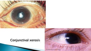 Conjunctival xerosis
 