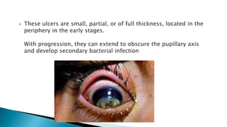  These ulcers are small, partial, or of full thickness, located in the
periphery in the early stages.
With progression, they can extend to obscure the pupillary axis
and develop secondary bacterial infection
 