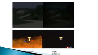 Normal vision Night
blindness
 