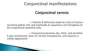 Conjunctival xerosis
->Vitamin A deficiency leads to a loss of mucus-
secreting goblet cells and eventually to squamous cell metaplasia of
the conjunctival epithelial cells.
->Conjunctiva becomes dry, thick, and wrinkled.
It gets keratinized, loses its normal transparency, and acquires a
smoky appearance
 