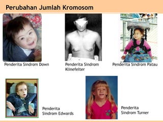 Perubahan Jumlah Kromosom
Penderita Sindrom Down Penderita Sindrom
Klinefelter
Penderita Sindrom Patau
Penderita
Sindrom Edwards
Penderita
Sindrom Turner
 