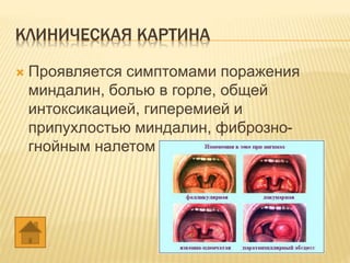 КЛИНИЧЕСКАЯ КАРТИНА
 Проявляется симптомами поражения
миндалин, болью в горле, общей
интоксикацией, гиперемией и
припухлостью миндалин, фиброзно-
гнойным налетом в устьях лакун.
 