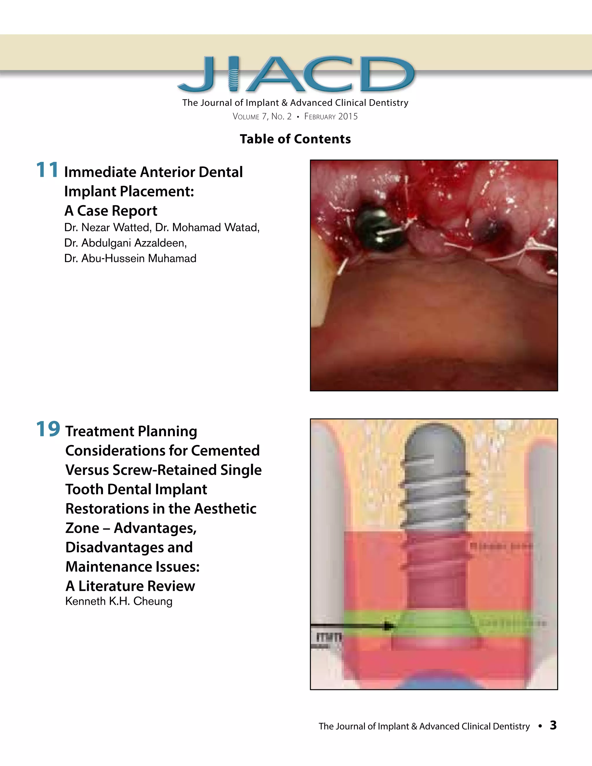 Immediate Anterior Dental Implant Placement:A Case Report | PDF