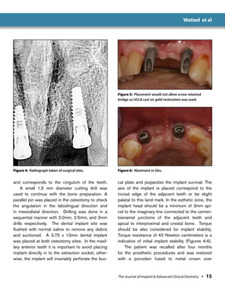 Immediate Anterior Dental Implant Placement:A Case Report | PDF