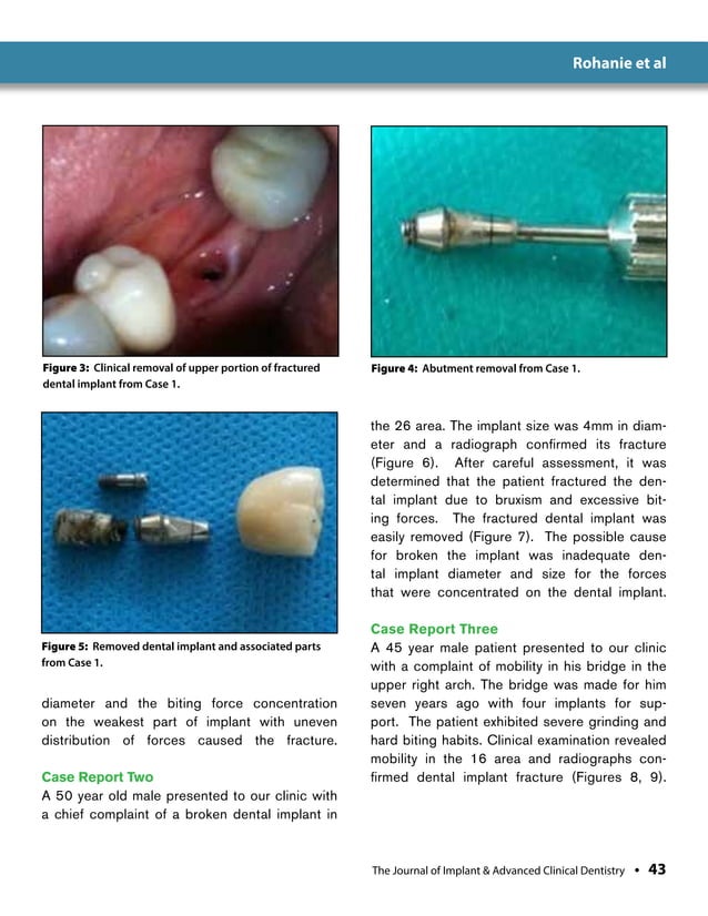Immediate Anterior Dental Implant Placement:A Case Report | PDF