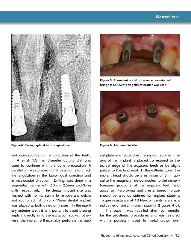 Immediate Anterior Dental Implant PlacementA Case Report
