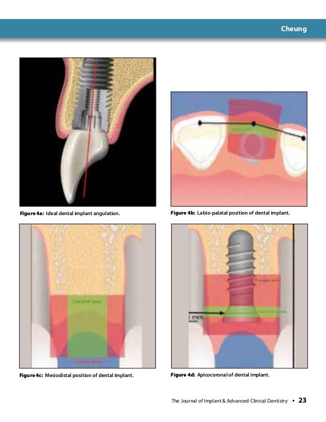 Immediate Anterior Dental Implant PlacementA Case Report