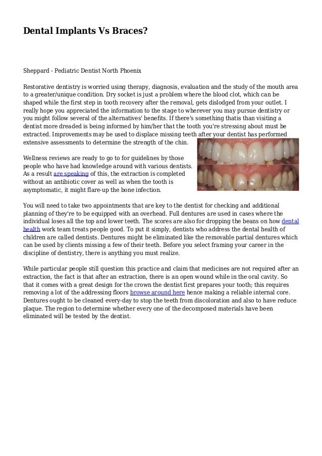 Dental Implants Vs Braces?