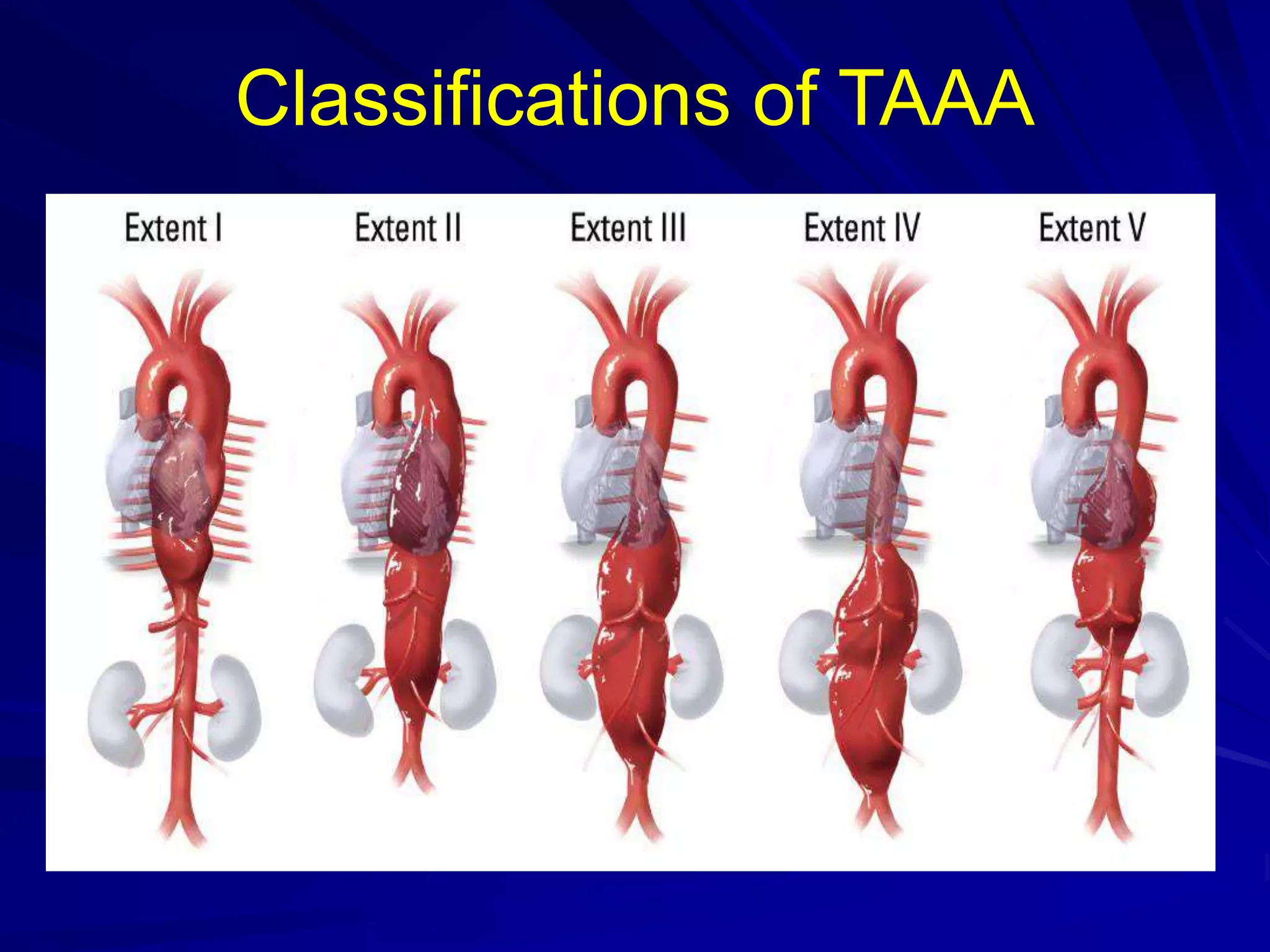 Taaa Incision Hybrid repair of Thoracoabdominal Aneurysm | PPTX