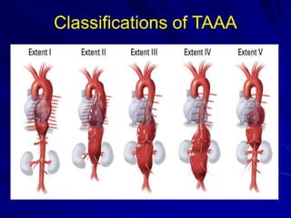 Hybrid repair of Thoracoabdominal Aneurysm | PPTX