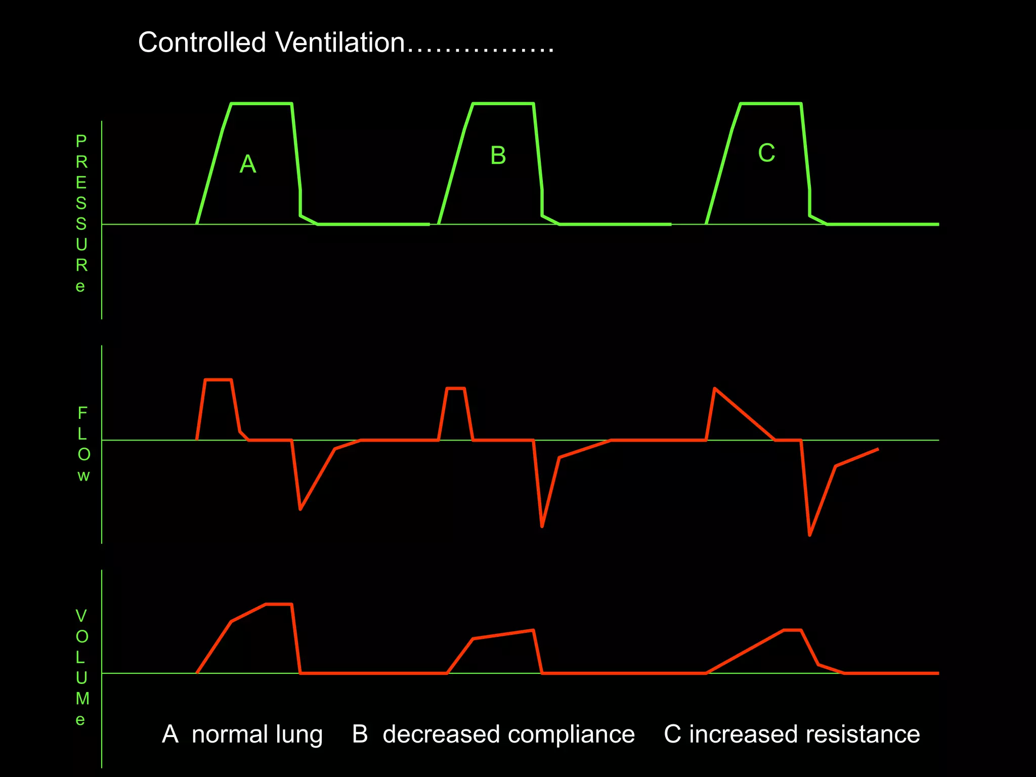 P
R
E
S
S
U
R
e
F
L
O
w
V
O
L
U
M
e
A B C
A normal lung B decreased compliance C increased resistance
Controlled Ventilation…………….
 