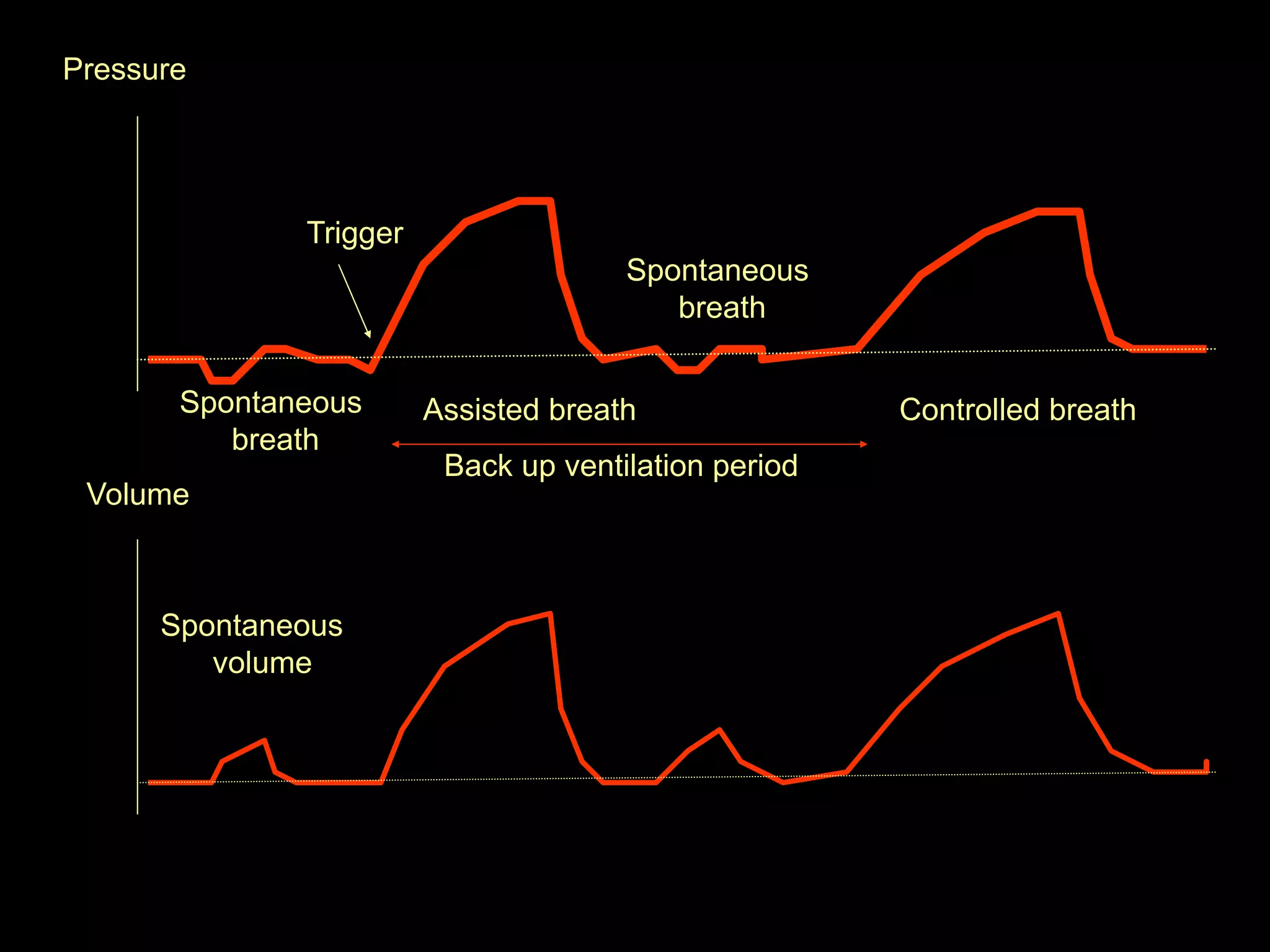 Spontaneous
breath
Assisted breath
Back up ventilation period
Controlled breath
Spontaneous
volume
Trigger
Spontaneous
breath
Pressure
Volume
 