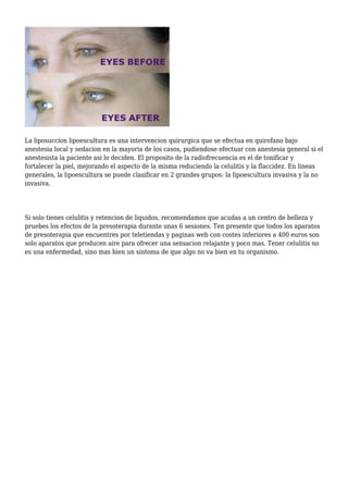 La liposuccion lipoescultura es una intervencion quirurgica que se efectua en quirofano bajo
anestesia local y sedacion en la mayoria de los casos, pudiendose efectuar con anestesia general si el
anestesista la paciente asi lo deciden. El proposito de la radiofrecuencia es el de tonificar y
fortalecer la piel, mejorando el aspecto de la misma reduciendo la celulitis y la flaccidez. En lineas
generales, la lipoescultura se puede clasificar en 2 grandes grupos: la lipoescultura invasiva y la no
invasiva.
Si solo tienes celulitis y retencion de liquidos, recomendamos que acudas a un centro de belleza y
pruebes los efectos de la presoterapia durante unas 6 sesiones. Ten presente que todos los aparatos
de presoterapia que encuentres por teletiendas y paginas web con costes inferiores a 400 euros son
solo aparatos que producen aire para ofrecer una sensacion relajante y poco mas. Tener celulitis no
es una enfermedad, sino mas bien un sintoma de que algo no va bien en tu organismo.
 