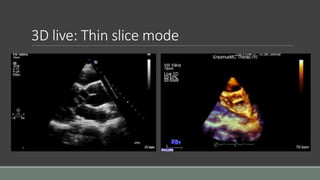 3D live: Thin slice mode 
 