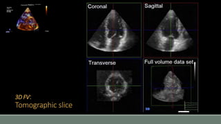 3D FV: 
Tomographic slice 
 