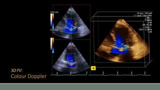 3D FV: 
Colour Doppler 
 