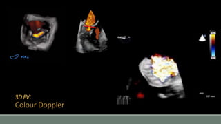 3D FV: 
Colour Doppler 
 