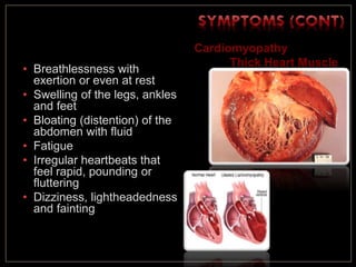 • Breathlessness with
exertion or even at rest
• Swelling of the legs, ankles
and feet
• Bloating (distention) of the
abdomen with fluid
• Fatigue
• Irregular heartbeats that
feel rapid, pounding or
fluttering
• Dizziness, lightheadedness
and fainting
Cardiomyopathy
Thick Heart Muscle
 