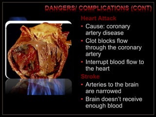 Heart Attack
• Cause: coronary
artery disease
• Clot blocks flow
through the coronary
artery
• Interrupt blood flow to
the heart
Stroke
• Arteries to the brain
are narrowed
• Brain doesn’t receive
enough blood
 