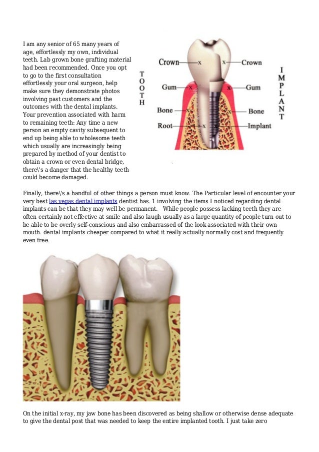 Mini Dental Implants Cost
