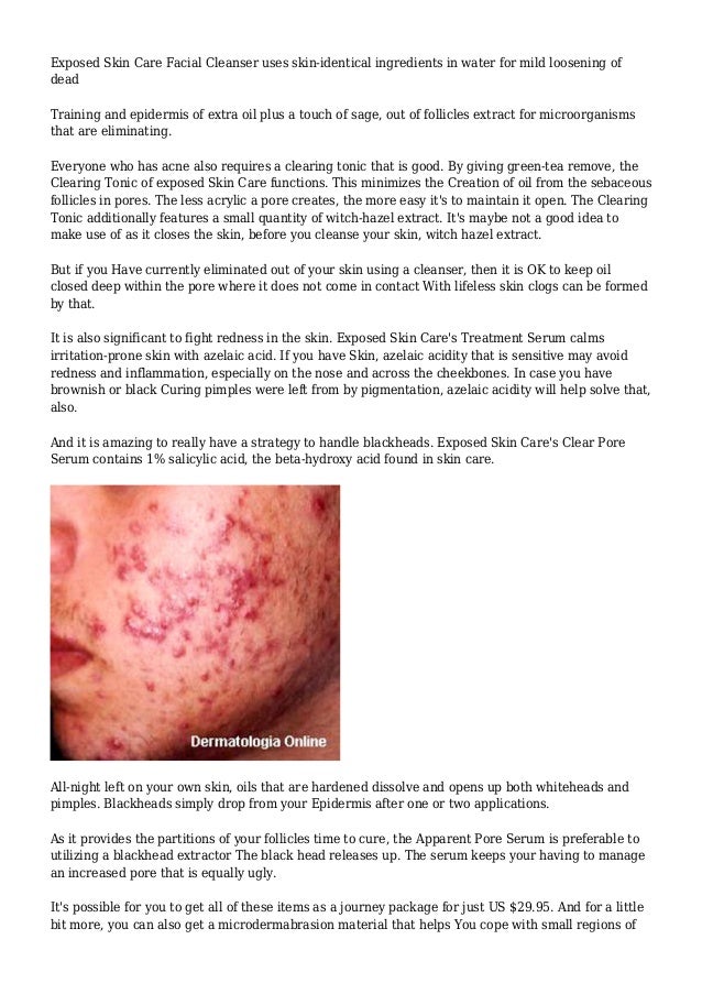 Top Five Funny Exposed Acne Treatment Quotes