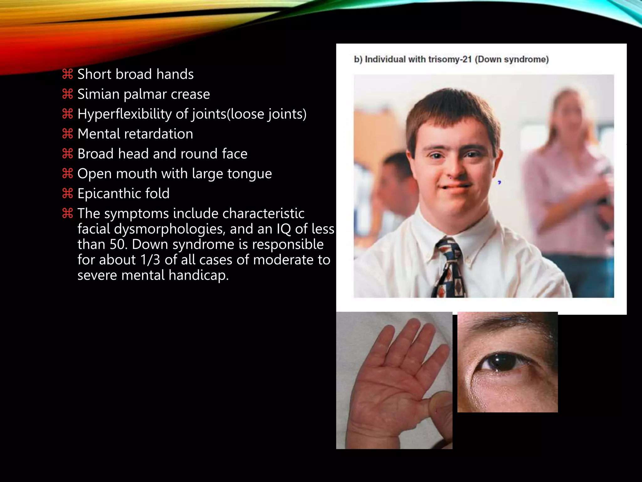  Short broad hands
 Simian palmar crease
 Hyperflexibility of joints(loose joints)
 Mental retardation
 Broad head and round face
 Open mouth with large tongue
 Epicanthic fold
 The symptoms include characteristic
facial dysmorphologies, and an IQ of less
than 50. Down syndrome is responsible
for about 1/3 of all cases of moderate to
severe mental handicap.
 
