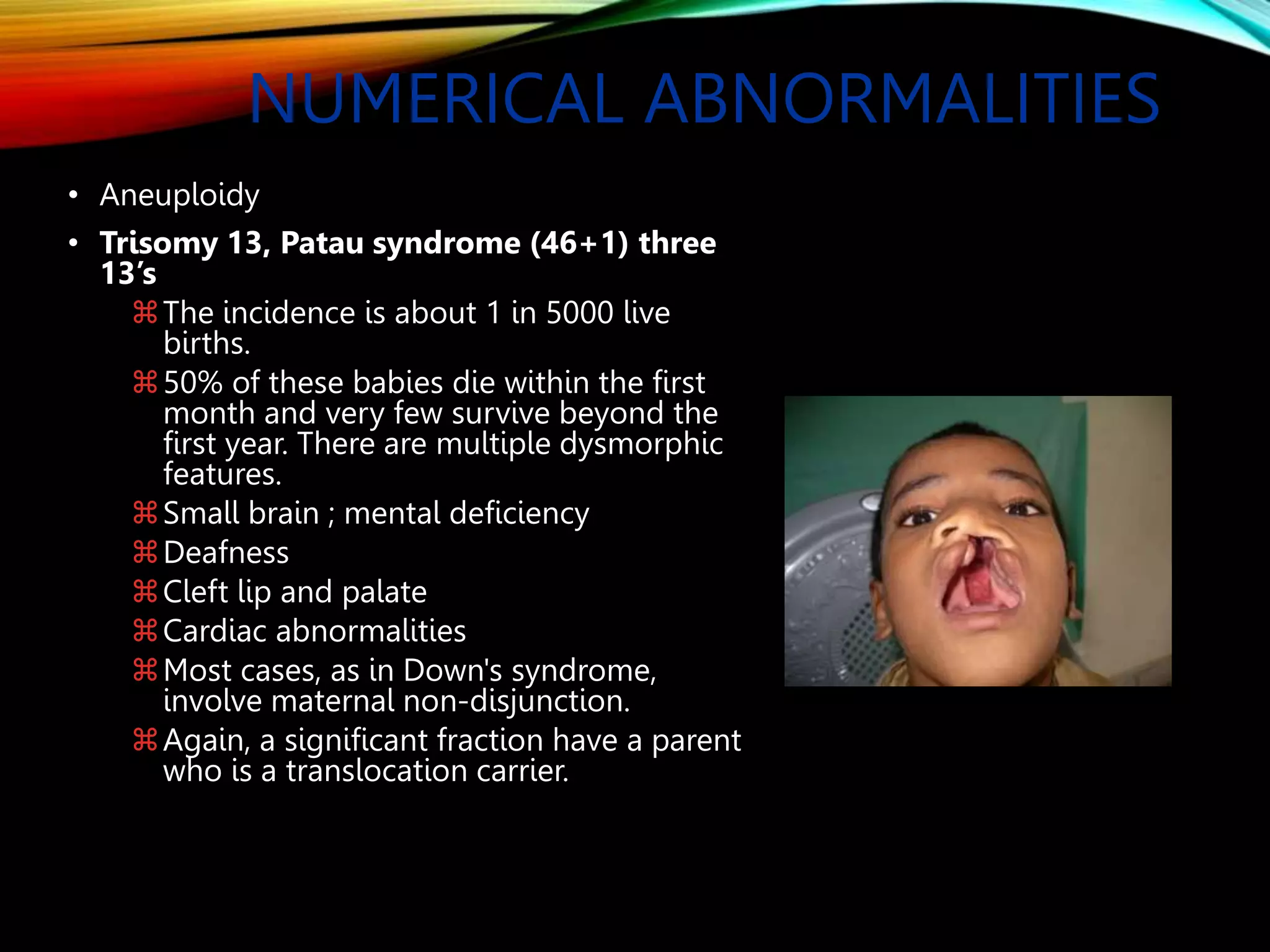 NUMERICAL ABNORMALITIES
• Aneuploidy
• Trisomy 13, Patau syndrome (46+1) three
13’s
The incidence is about 1 in 5000 live
births.
50% of these babies die within the first
month and very few survive beyond the
first year. There are multiple dysmorphic
features.
Small brain ; mental deficiency
Deafness
Cleft lip and palate
Cardiac abnormalities
Most cases, as in Down's syndrome,
involve maternal non-disjunction.
Again, a significant fraction have a parent
who is a translocation carrier.
 