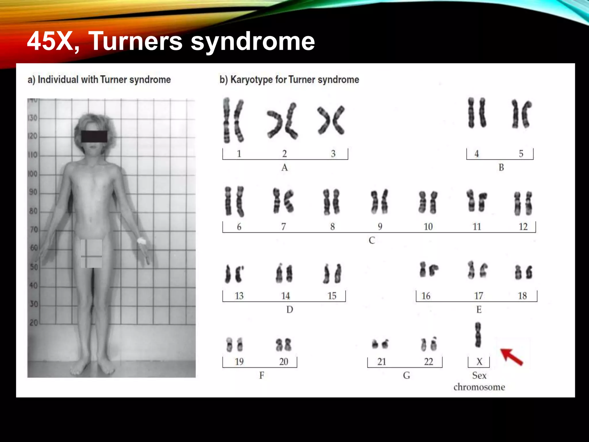45X, Turners syndrome
 