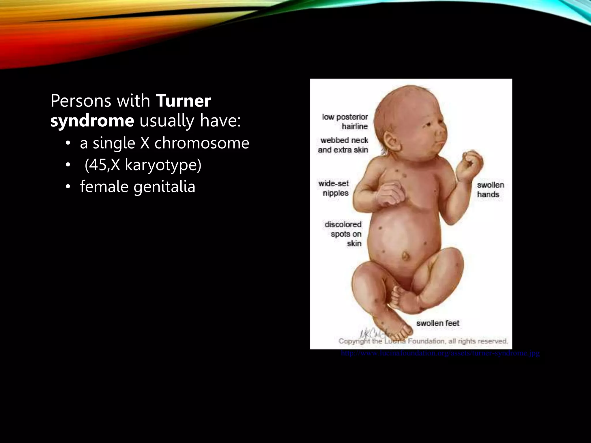 Persons with Turner
syndrome usually have:
• a single X chromosome
• (45,X karyotype)
• female genitalia
http://www.lucinafoundation.org/assets/turner-syndrome.jpg
 