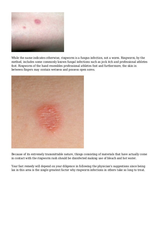 Do You Know How To Prevent Acknowledge And Cure Ringworm