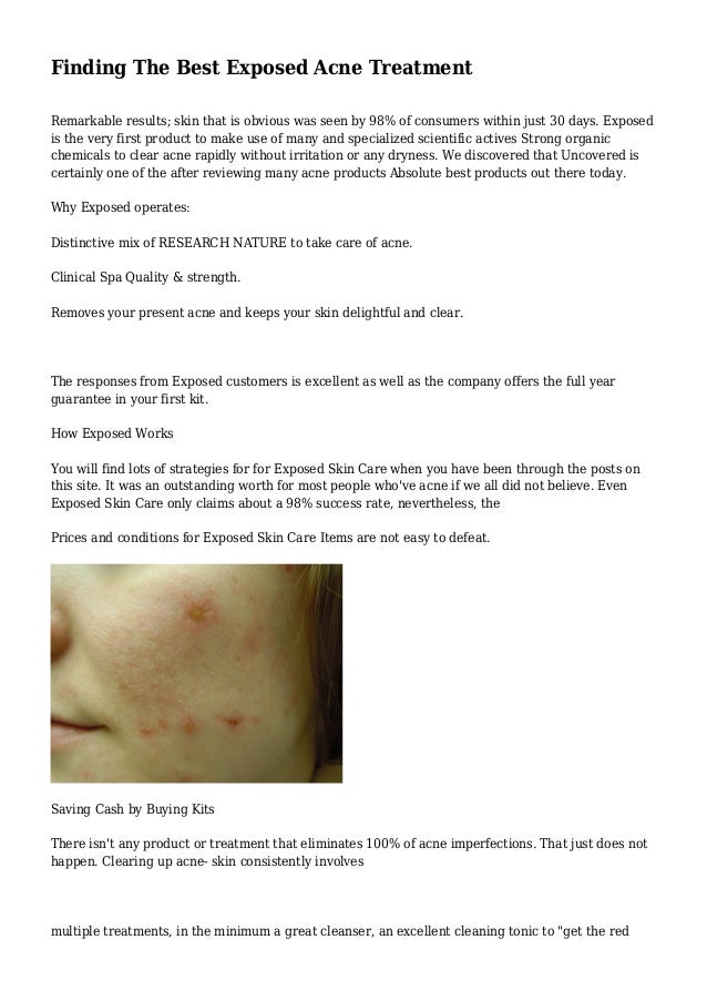exposed acne