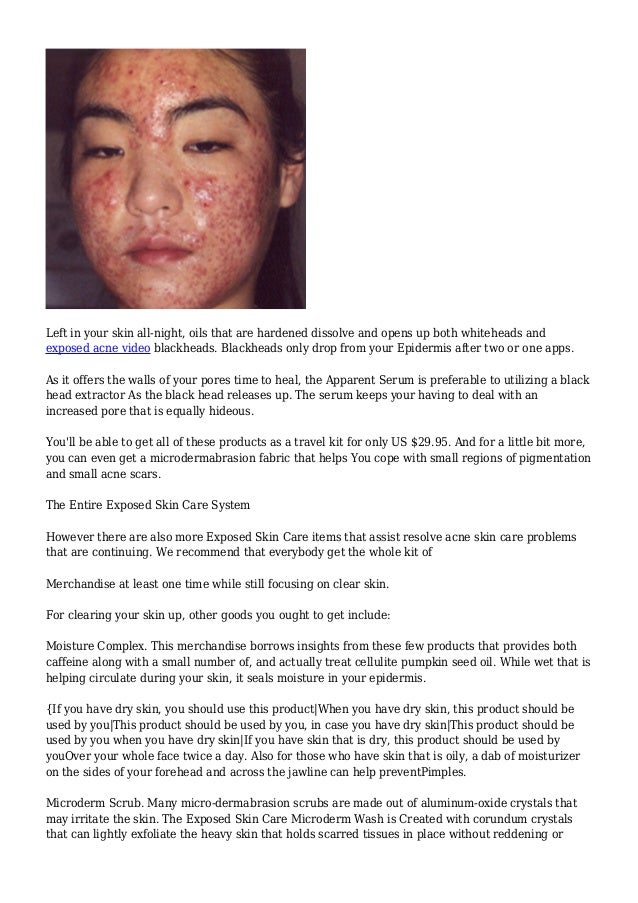 exposed skin care moisture complex