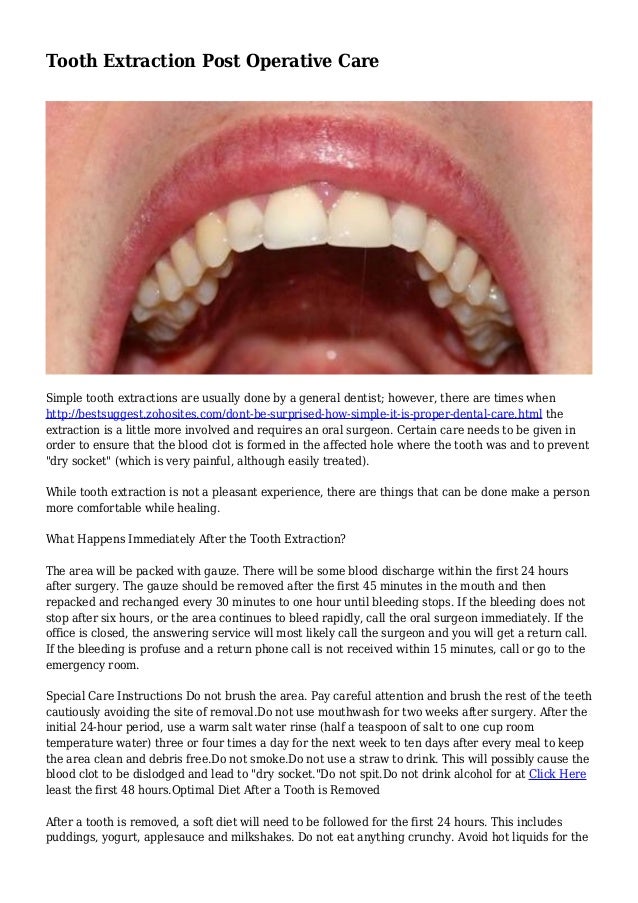 Tooth Extraction Post Operative Care