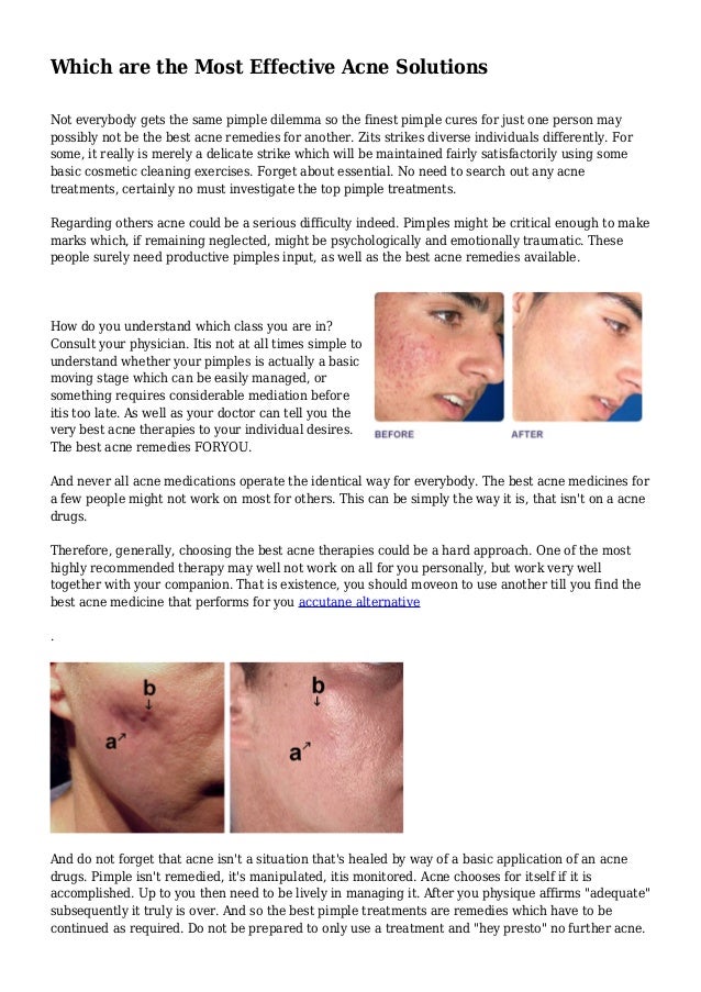 most effective acne medication