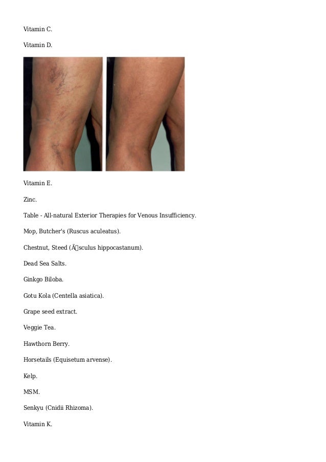 vitamin c spider veins