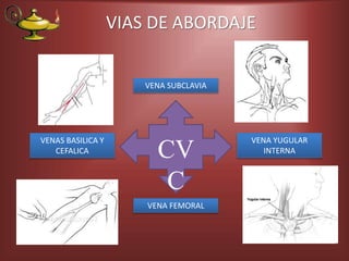 VIAS DE ABORDAJE
VENA FEMORAL
VENAS BASILICA Y
CEFALICA
VENA YUGULAR
INTERNA
VENA SUBCLAVIA
CV
C
 
