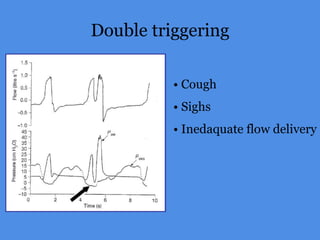 Double triggering
• Cough
• Sighs
• Inedaquate flow delivery
 