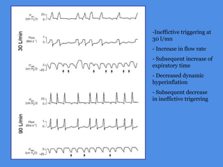 -Ineffictive triggering at
30 l/mn
- Increase in flow rate
- Subsequent increase of
expiratory time
- Decreased dynamic
hyperinflation
- Subsequent decrease
in ineffictive trigerring
 