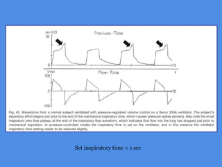 Set inspiratory time < 1 sec
 