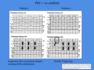 PSV = 10 cmH2O
Inspiratoy flow terminate despite
continued Pes defelection
Double Trigerring
Patient 1 Patient 2
 