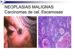 NEOPLASIAS MALIGNAS
Carcinomas de cel. Escamosas
 