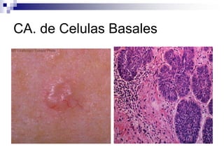 CA. de Celulas Basales
 