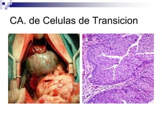 CA. de Celulas de Transicion
 