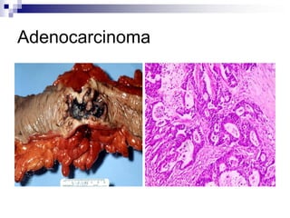 Adenocarcinoma
 