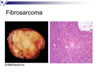 Fibrosarcoma
 