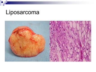 Liposarcoma
 
