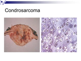 Condrosarcoma
 