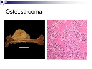 Osteosarcoma
 