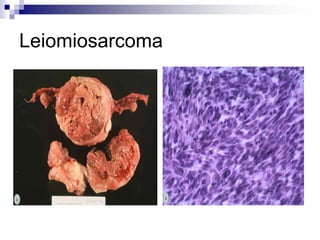 Leiomiosarcoma
 