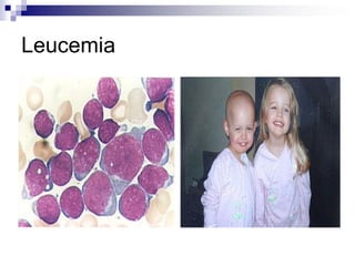 Leucemia
 